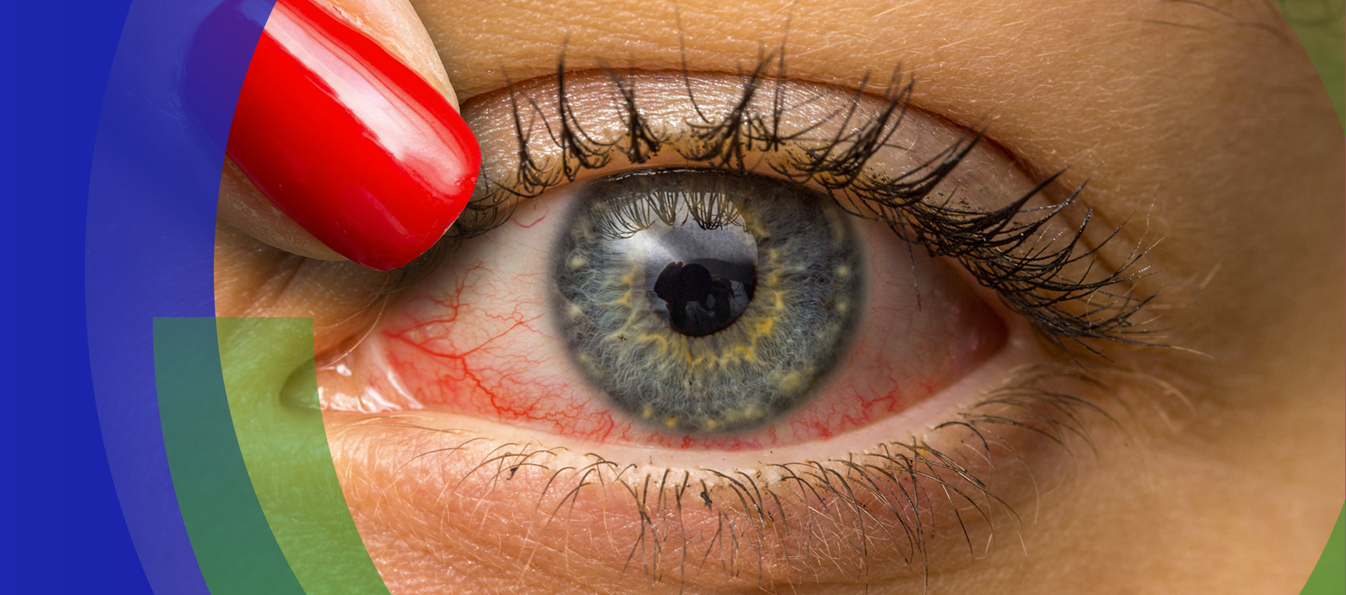 Não deixe o glaucoma roubar sua visão: prevenção e cuidados para uma vida com clareza